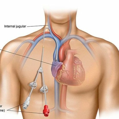 Stream Difference Between Temporary And Permanent Dialysis Catheters by