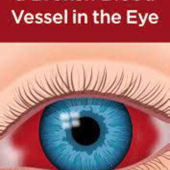 Best Eye Blood Vessel Burst Treatment Reviews
