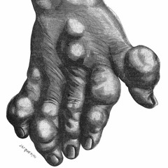 Finger Blisters