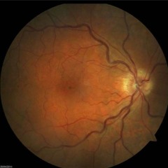 Glōkøm - Cataracte