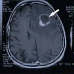 glioblastoma