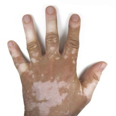 vitiligo [ prod. acidproof! ]