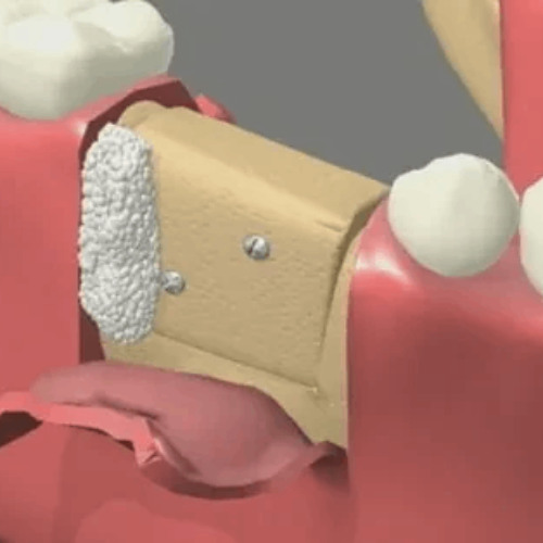 Simple Step-by-Step Guide to Bone Grafting in Washington