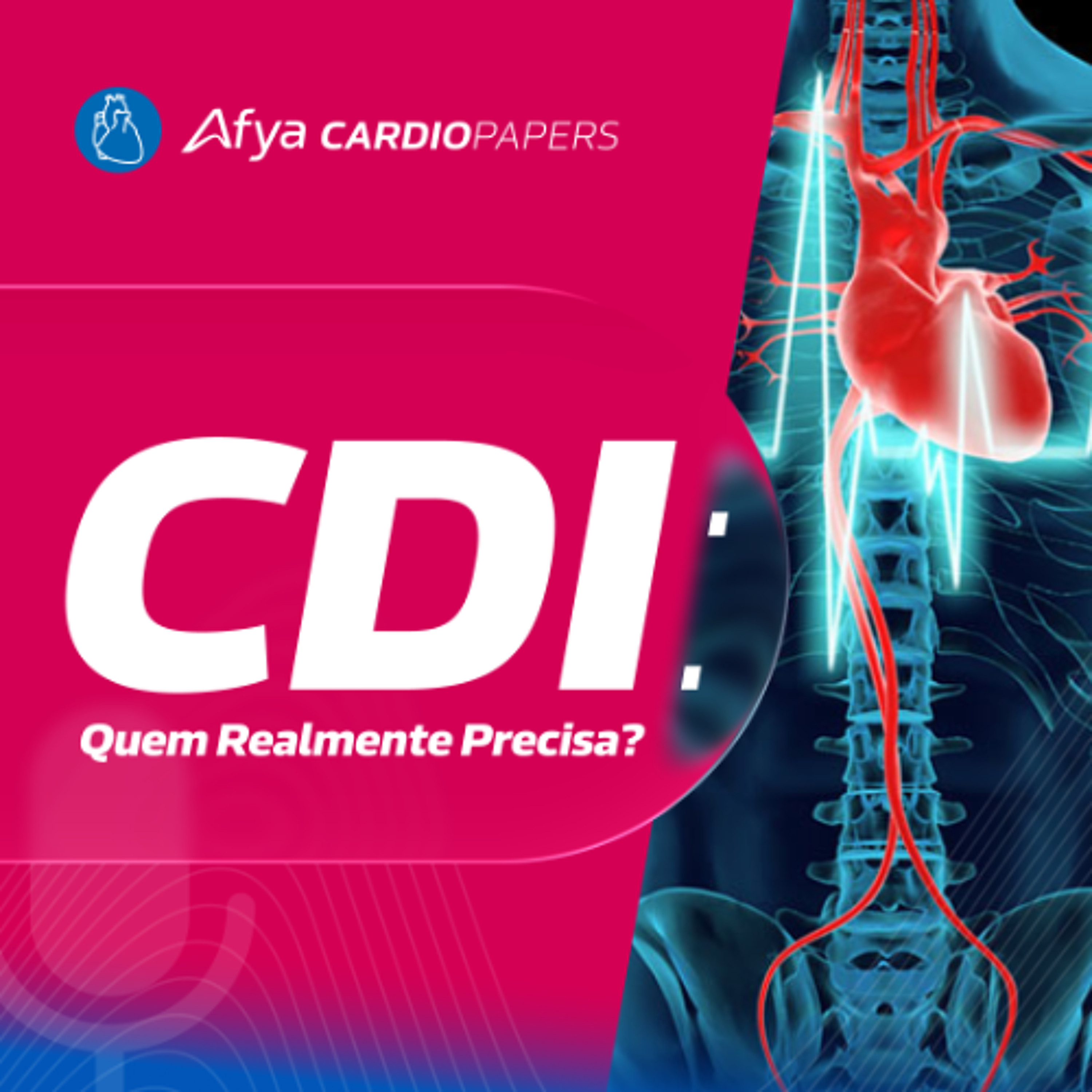 Estratificação de Risco e CDI na Cardiomiopatia Arritmogênica