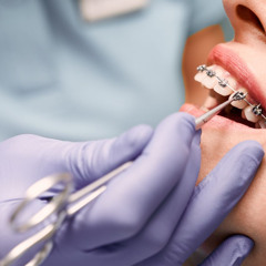 Complete Guide to Dental Cleanings and Types of Braces | All Smiles Podcast