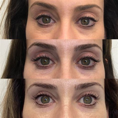 Best Under Eye Puffiness Laser Treatment Reviews