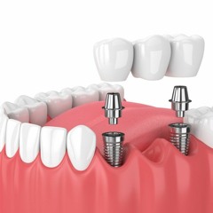 Partial Teeth Implants In Ellicott City