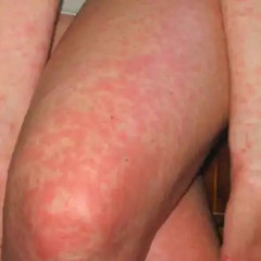 ALERGIA / ALERGY