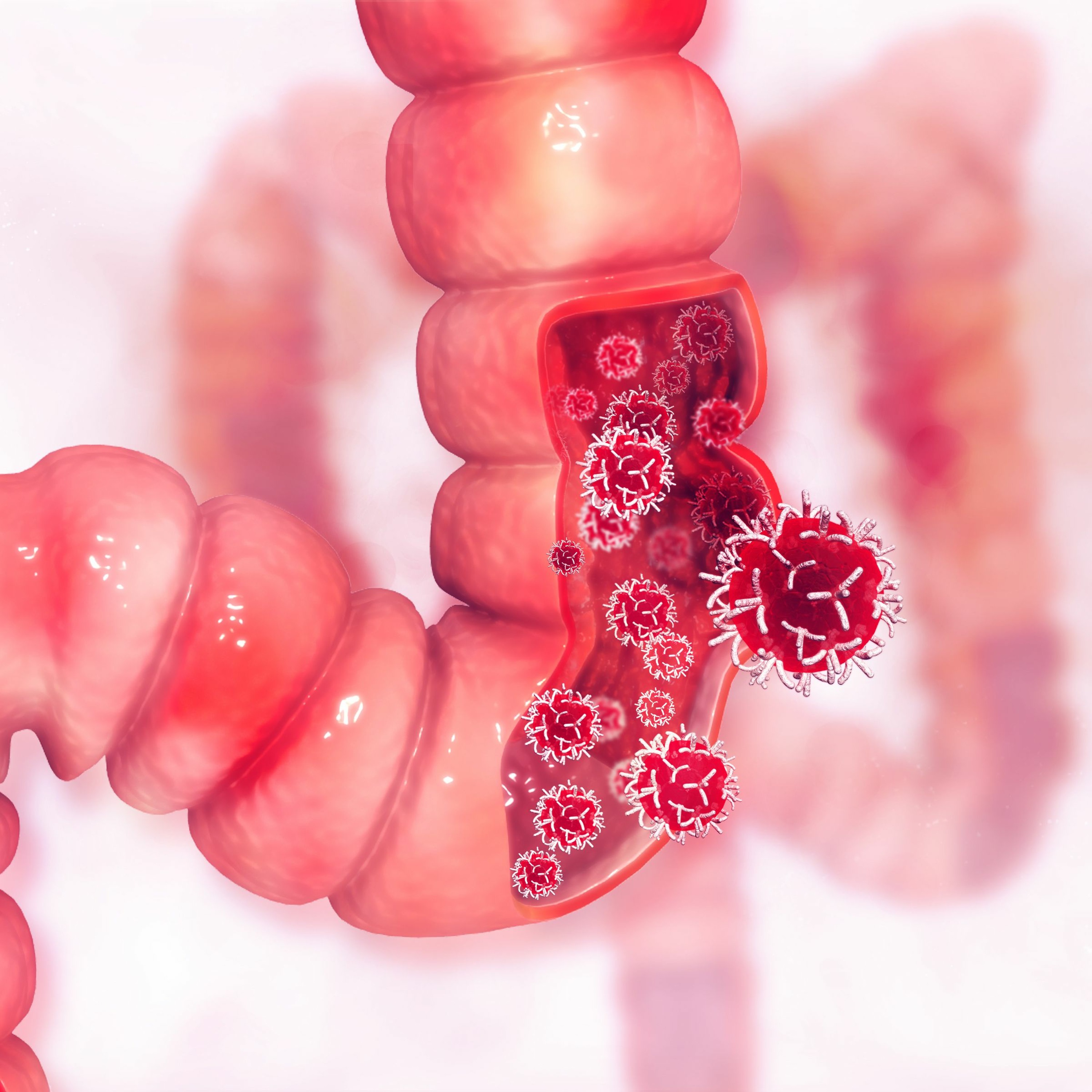 Colorectal Cancer - Pathologists’ Key Role in Improving Patient Care episode artwork