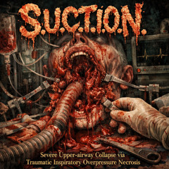 Severe Upper airway Collapse via Traumatic Inspiratory Overpressure Necrosis