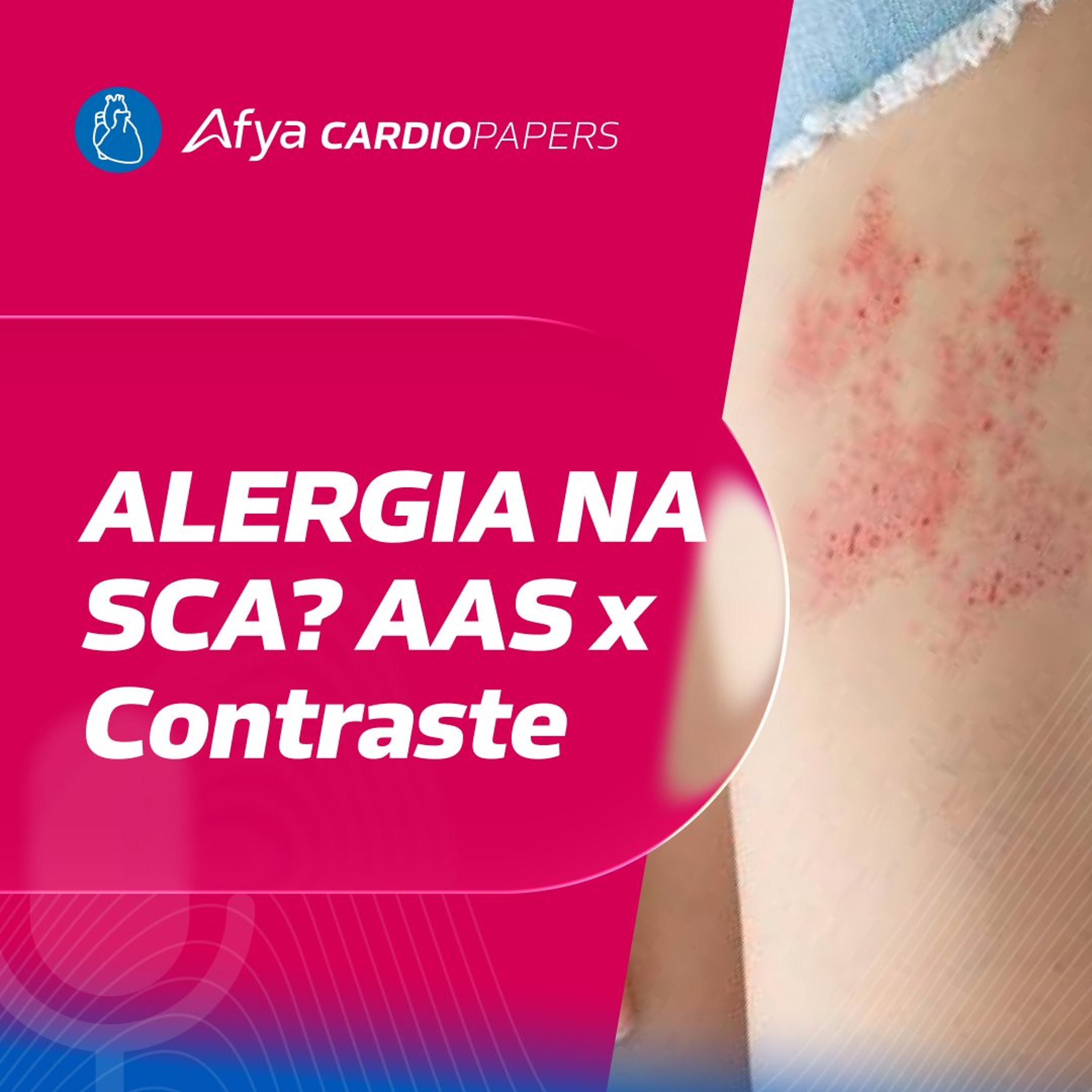 Alergia a AAS e contraste na SCA: como manejar com segurança sem atrasar a reperfusão?