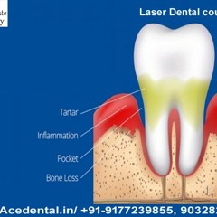 Learn Laser Dental courses and Internship in India