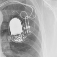 pacemaker generator