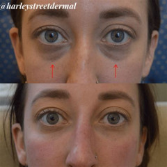Best Treatment For Dark Circles Eyes Reviews