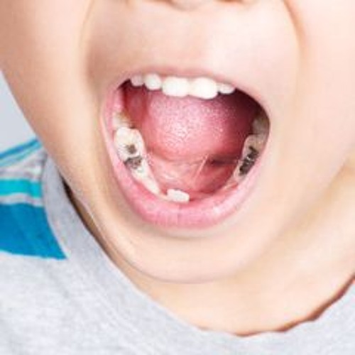 How To Prevent Cavities A Guide For Parents On Kids Dental Care