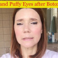 Best Puffy Eyes 2 Weeks After Botox Treatment Reviews