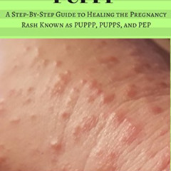 [FREE] EBOOK 🗂️ Goodbye PUPPP: A Step-by-Step Guide to Healing the Pregnancy Rash Kn
