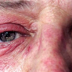 Best Poison Ivy Around Eyes Treatment Reviews