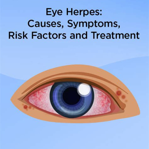 Best Herpes Eye Infection Treatment Reviews