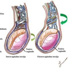 Testicular Torsion Distortion