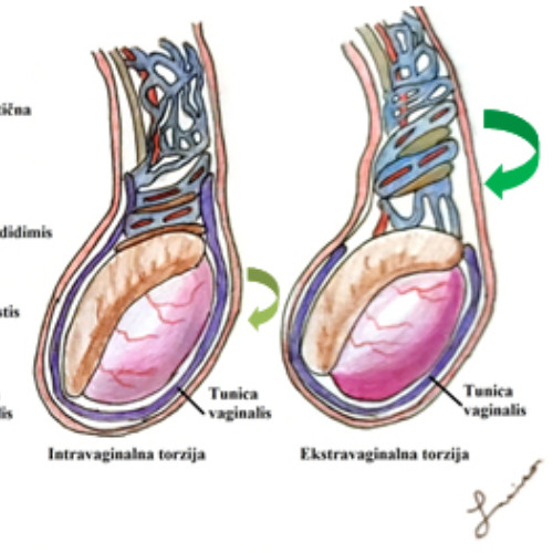 Testicular Torsion Distortion