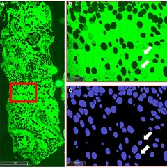Bone Marrow Adipocytes Provide Early Sign of Progression from MGUS to Multiple Myeloma
