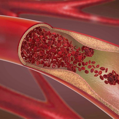 Artery Plaque Removal | Get Rid of Artery Plaque & Protect Heart and Brain Health
