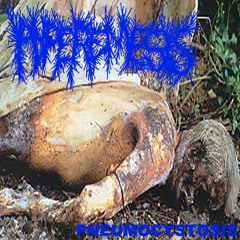 HYPEREMESIS - Necrotizing fasciitis of the breast following quandrantectomy
