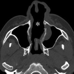 Snqg v nosa mi, snqg navun