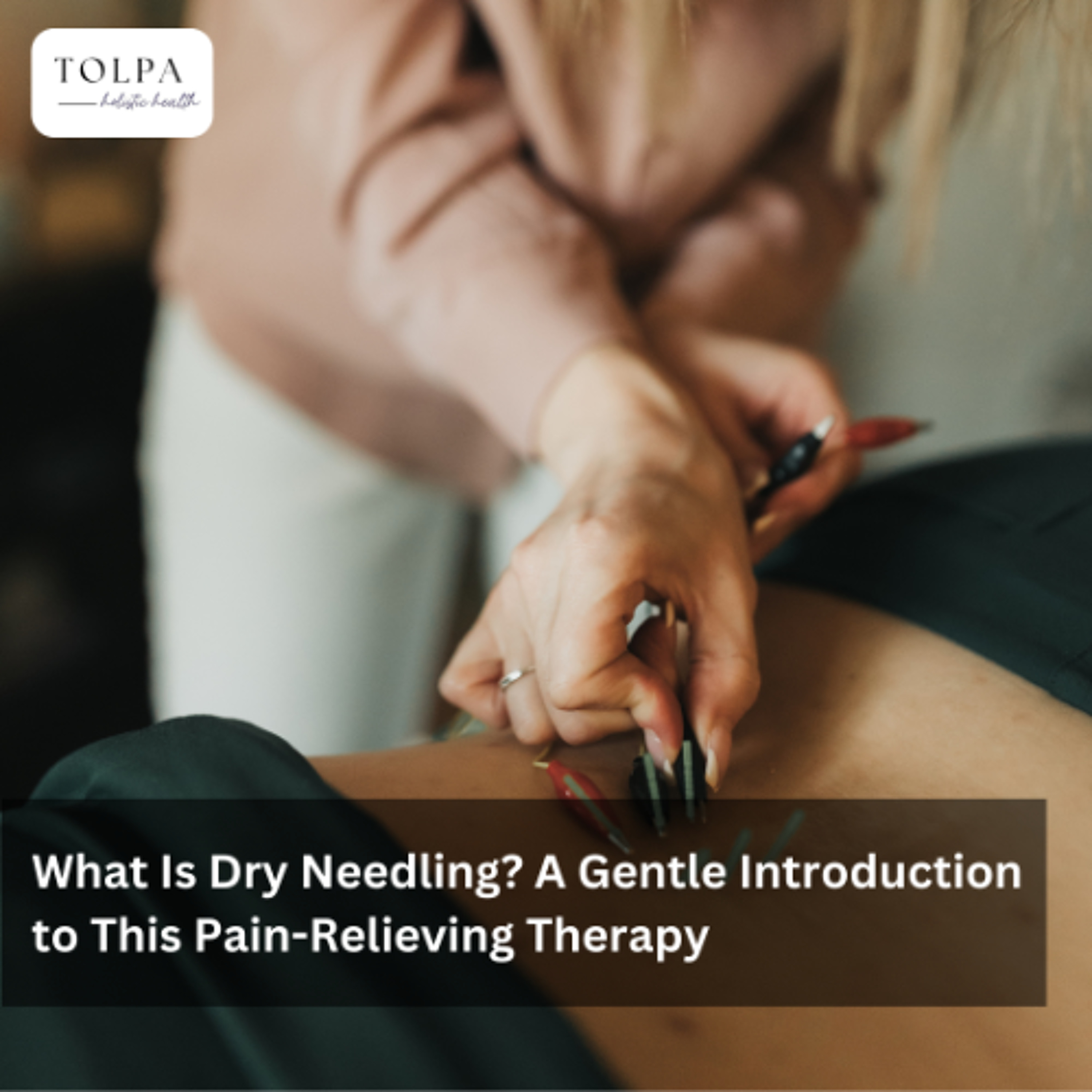 What Is Dry Needling? A Gentle Introduction to This Pain-Relieving Therapy