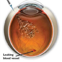 Best Treatment For Leaking Blood Vessel In Eye Reviews