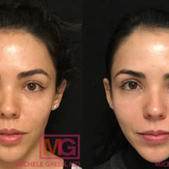 Best Non Surgical Under Eye Treatments Reviews