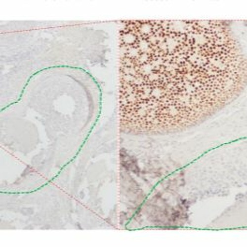 Multiclonality of Estrogen Receptor Expression in Ductal Carcinoma in Situ (DCIS)
