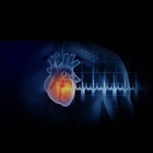 Heart Attack