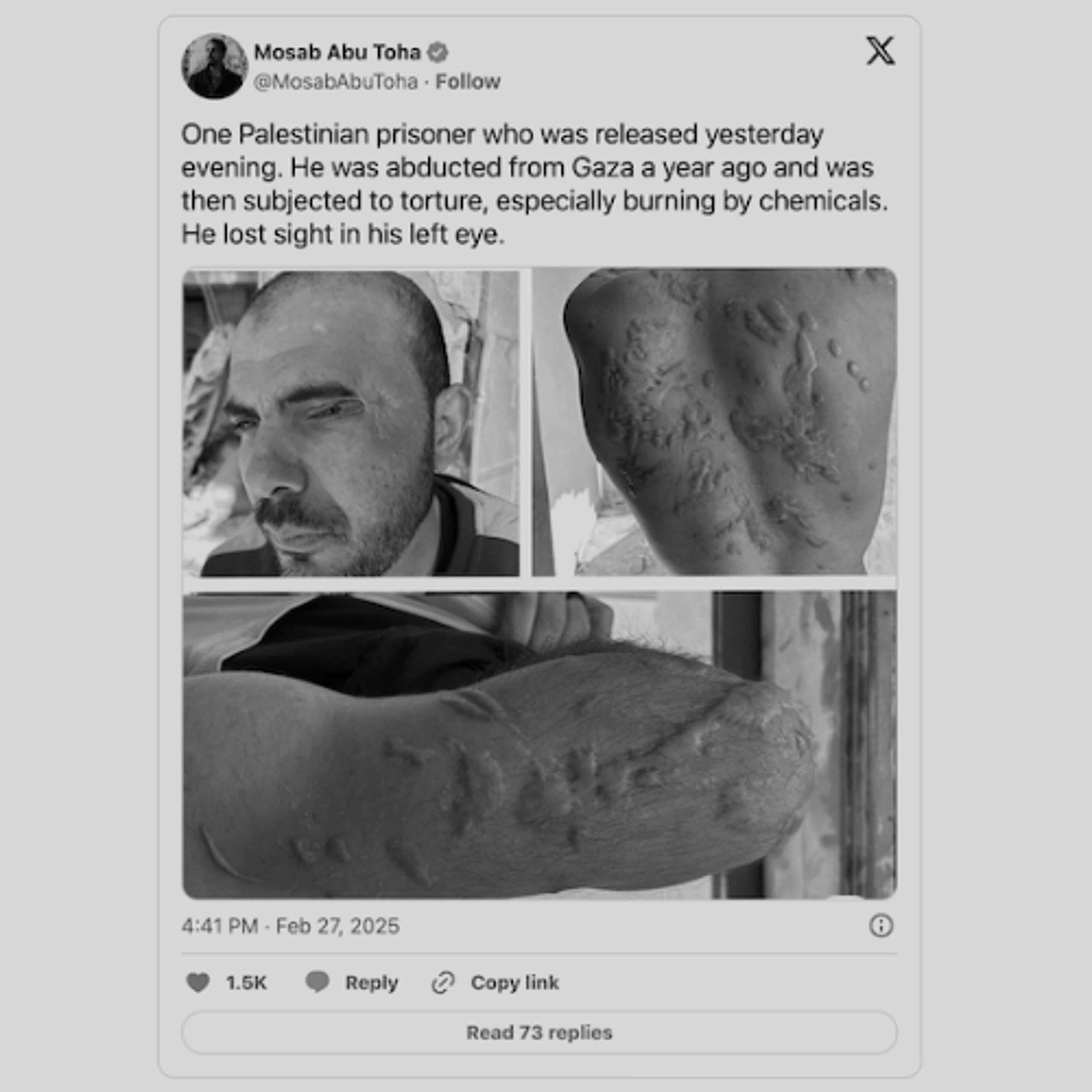 Palestinian Hostage Released With Obvious Torture Scars; Western Press Ignores Him