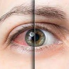The most common eye problem is eye dryness