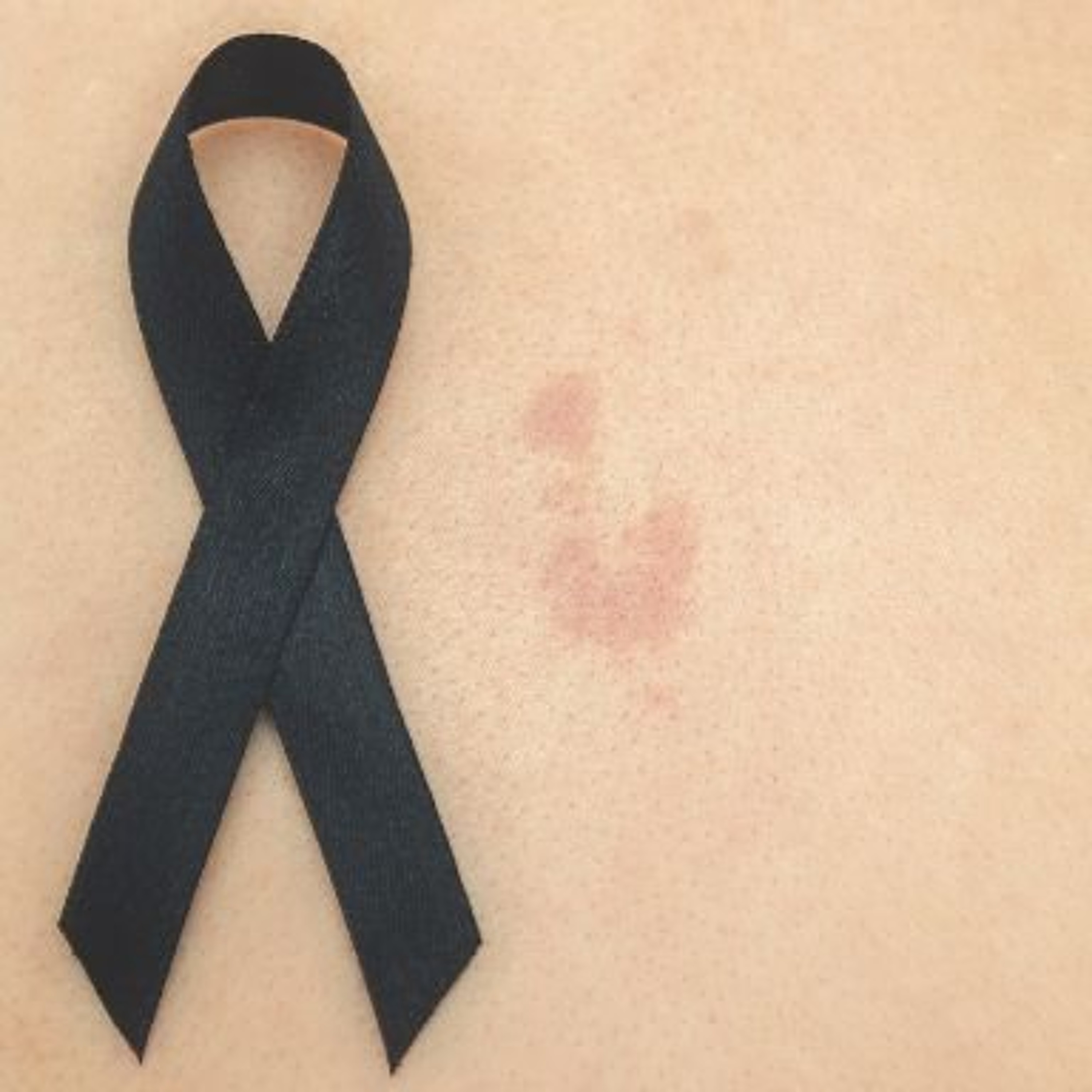 Quin Skin Cancer Survivor Reacts To Development Of Melanoma Vaccine
