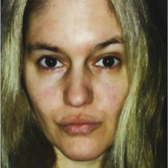57. eczema