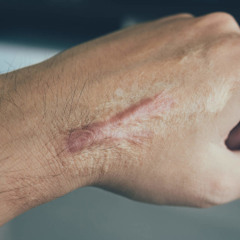 SCARS