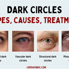 Best Dark Circles Under The Eyes Treatment Reviews