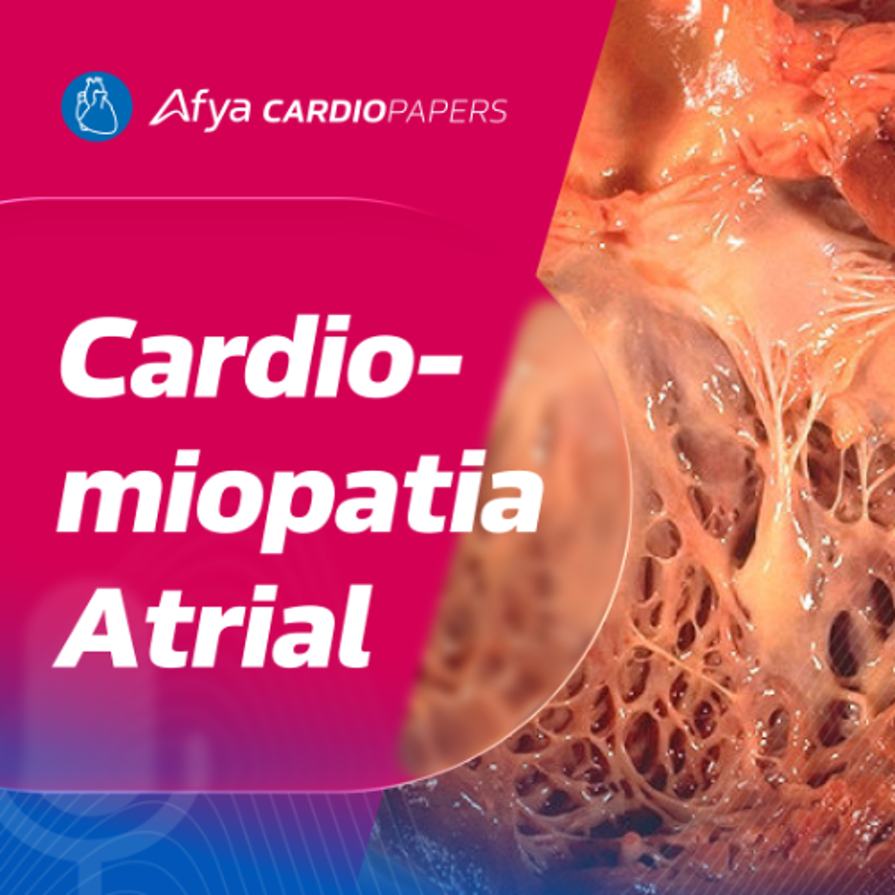 Cardiomiopatia Atrial - Quando a IC começa pelos átrios