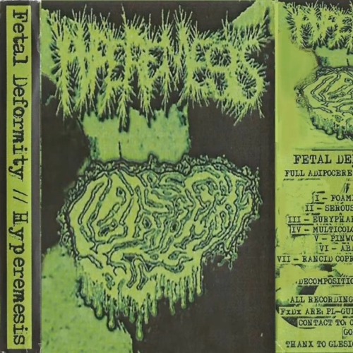 fetal deformity- side of hyperemesis split