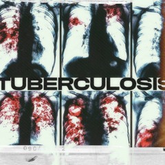 TUBERCULOSIS