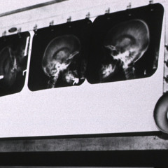 Aneurysma