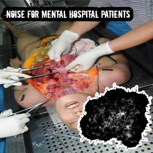 Hyperphosphatasia with Impaired Intellectual Development Syndrome
