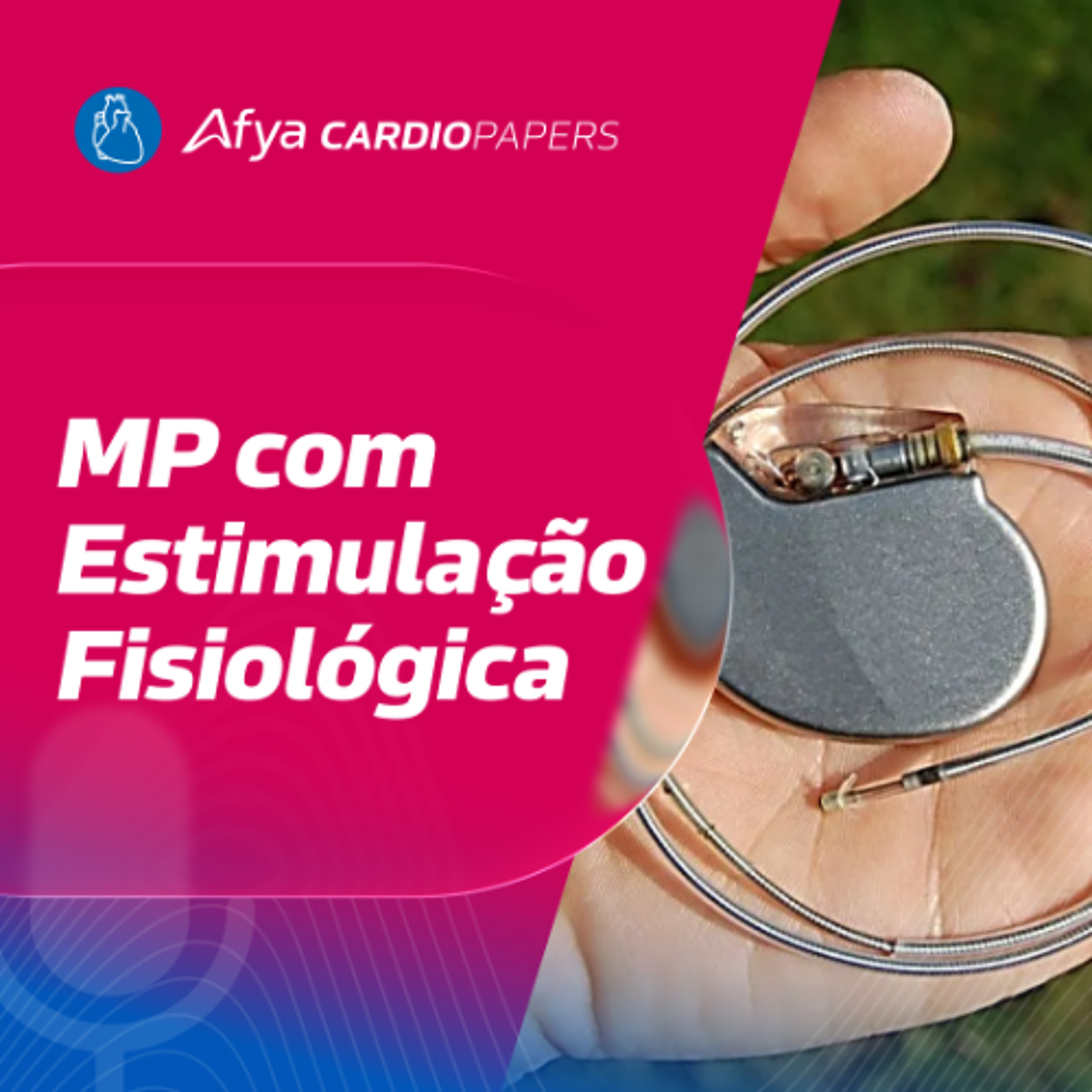 MP com Estimulação Fisiológica