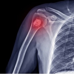 Blog: Targeting Fatty Acid Binding Proteins in Multiple Myeloma