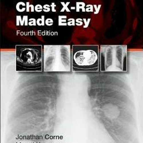 Chest X Ray Made Easy How To Read Chest X Ray Systema vrogue.co