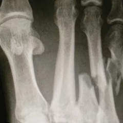 BROKENFOOTWORK twofoot