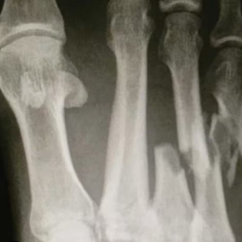 BROKENFOOTWORK twofoot